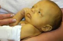 Parents urged to send their yellow babies to hospital